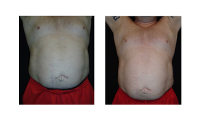 Fat loss of over 5 inches in one treatment.